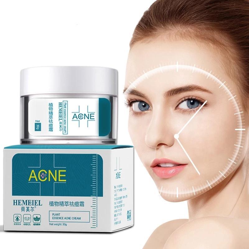 Akne Creme – Beruhigend & wirksam